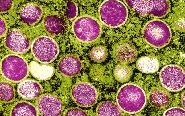 Vírus da mpox é detectado no Paquistão; UE eleva nível de alerta