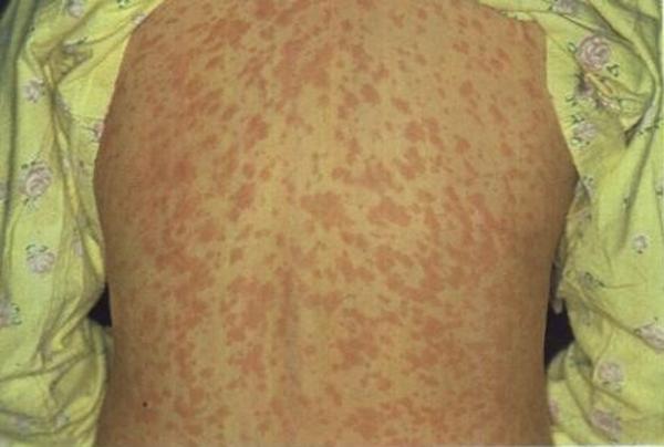 Manchas vermelhas pelo corpo podem aparecer em pessoas que contra&iacute;ram sarampo.(Imagem:Divulga&ccedil;&atilde;o/Sesa-ES)