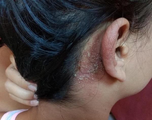 Estudante foi v&iacute;tima do pot&oacute; enquanto dormia.(Imagem:Arquivo pessoal)
