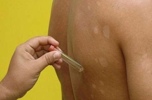 Casos suspeitos de hanseníase são examinados em mutirão