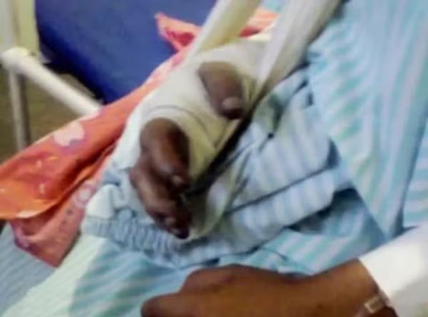 Bra&ccedil;o da crian&ccedil;a ficou escuro devido &agrave; infec&ccedil;&atilde;o e foi amputado em hospital.(Imagem:Tacyane Machado)