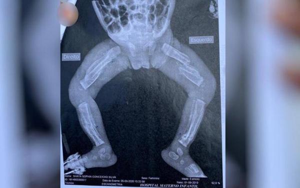 Bebê é internada com 12 fraturas pelo corpo; pais do MA foram presos