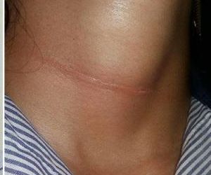 Mulher é vítima de pipa com cerol