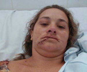 Agredida com facão pelo ex-marido, mulher precisa de reconstituição da gengiva