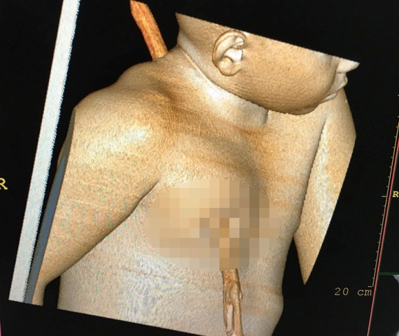 Menino cai de árvore e fica com estaca atravessada em seu corpo no PI