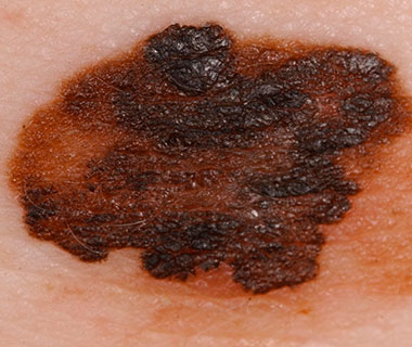 Melanoma: simpósio abordará doença com especialistas em Teresina