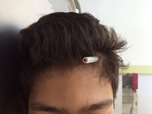 Aluno crava lápis na cabeça de colega durante briga em escola